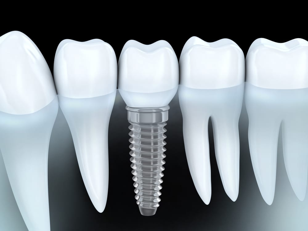 Dental Implants, Laraway Family Dentistry, Family Dentist in the Woodlands, TX 
